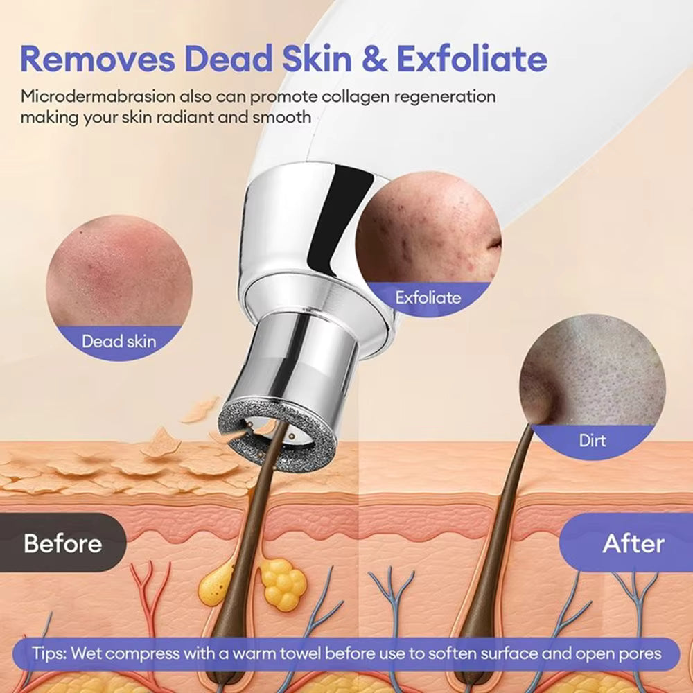 3-Tip Portable Diamond Microdermabrasion & Vacuum Blackhead Remover