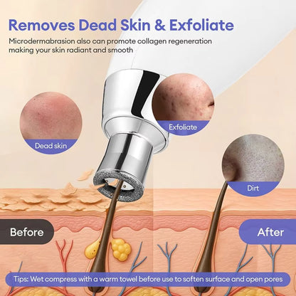 3-Tip Portable Diamond Microdermabrasion & Vacuum Blackhead Remover
