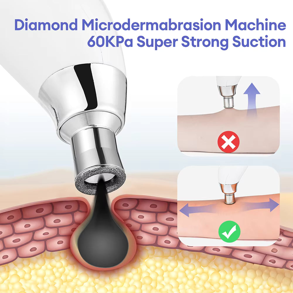 3-Tip Portable Diamond Microdermabrasion & Vacuum Blackhead Remover